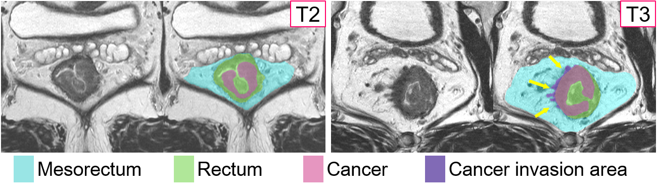 Relación entre el cáncer de recto y tejidos.